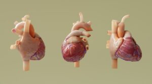 Photo Infarct symptoms