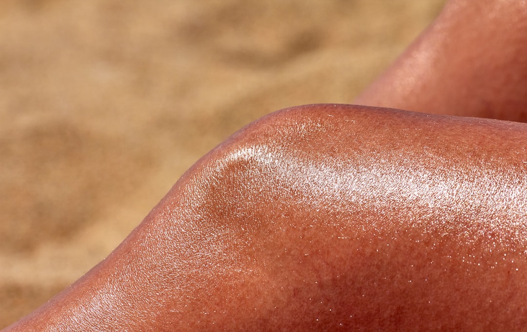 Photo naturist treatment for sunburn